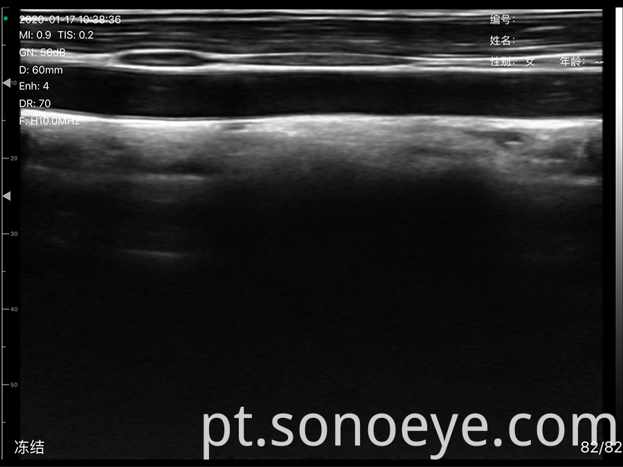 Super Width Linear Probe Type Wireless Mini Ultrasound